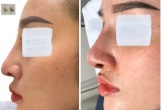 Nâng mũi, cô gái ở Vĩnh Long bị nhiễm trùng lòi cả sống mũi