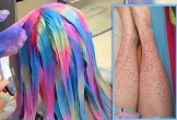 Cô gái 20 tuổi trả giá đắt vì nhuộm tóc liên tục