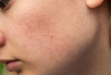 Mụn ẩn dưới da: “Kẻ thù vô hình” của làn da và 3 bước xử lý hiệu quả