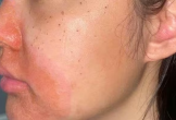 Cảnh báo biến chứng viêm da tiếp xúc nặng sau peel da tại spa